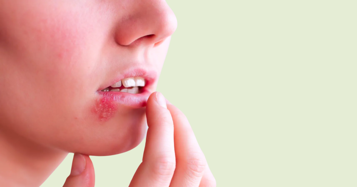 Oral & Genital Herpes: Causes, Symptoms and Treatments in Singapore
